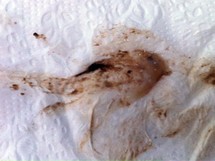 бурые выделения при миоме фото