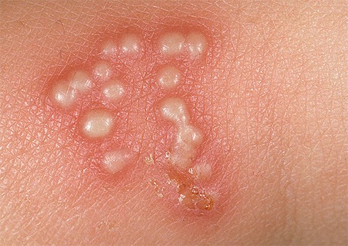 как начинается герпес перед месячными