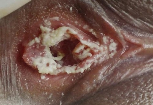 фото молочницы на половых губах у женщины