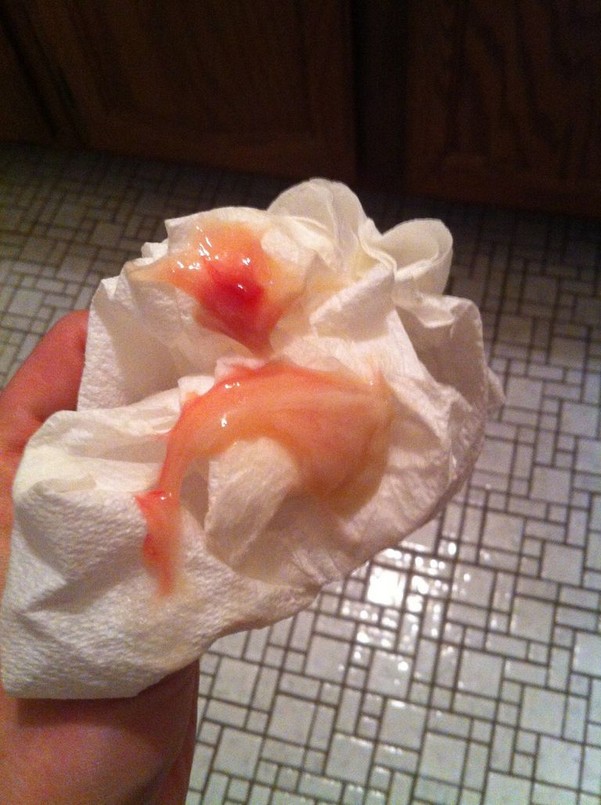 фото слизистых выделений при беременности с кровью