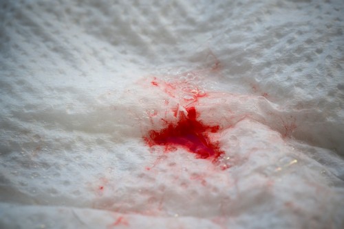 Ярко красные выделение на ранних сроках беременности фото