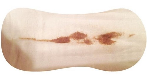 Коричневые выделения при беременности на ранних сроках