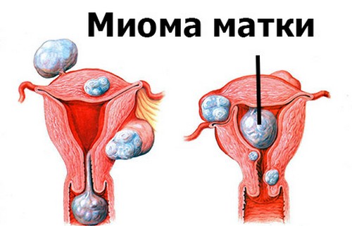 миома матки