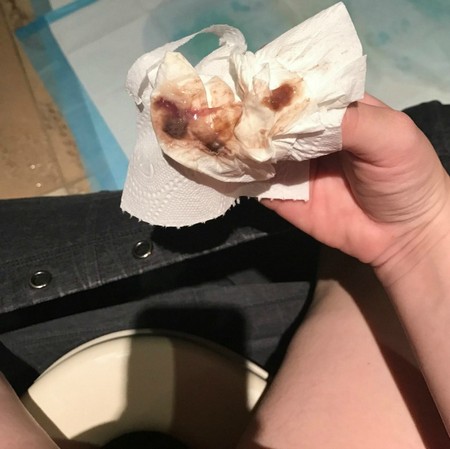 коричнево -бардовые выделения