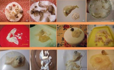 результат после использования Beautiful Life и Clean Point