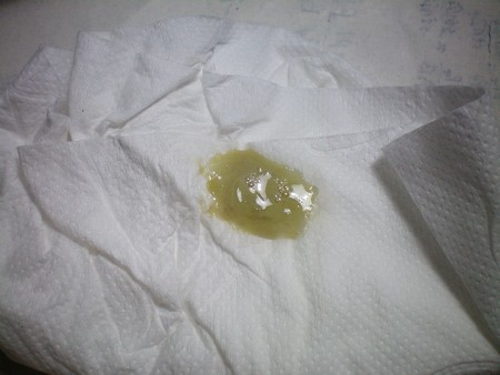 Зеленые влагалищные выделения